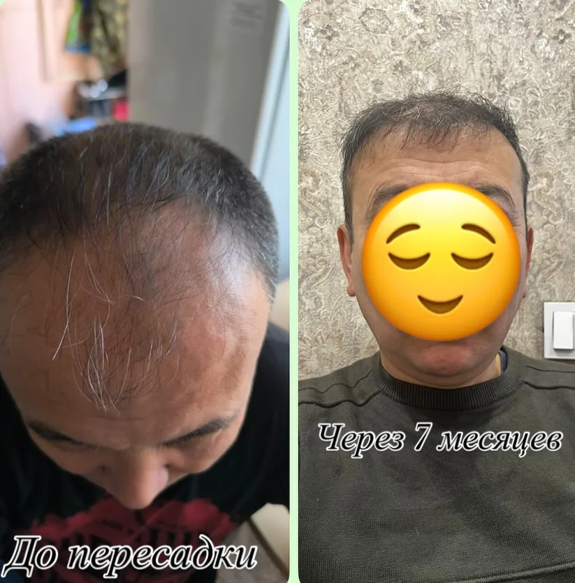 Темя пациента до пересадки и через 7 месяцев